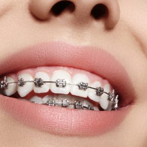 Có nên niềng răng khi đã trưởng thành?
