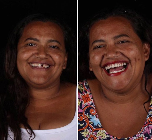 Hình ảnh người phụ nữ Brazil được chỉnh nha trước và sau